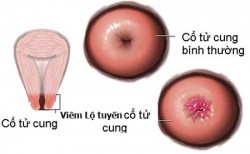 Viêm lộ tuyến cổ tử cung