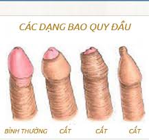 Khắc phục hẹp bao quy đầu