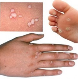 Lây nhiễm qua viết thương hở cũng là nguyên nhân sùi mào gà