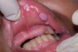 Triệu chứng bệnh sùi mào gà ở môi