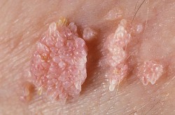 Triệu chứng bệnh sùi mào gà ở nam giới