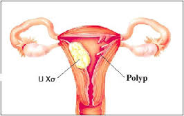 Biểu hiện polyp cổ tử cung