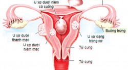 Bệnh u xơ tử cung và cách điều trị hiệu quả nhất