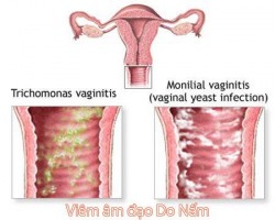 Bệnh viêm âm đạo