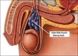 Giãn tĩnh mạch thừng tinh là bị bệnh gì