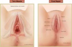 Trước và sau khi thu hẹp âm đạo