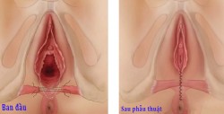 Phương pháp thu hẹp âm đạo