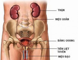 Điều trị viêm đường tiết niệu
